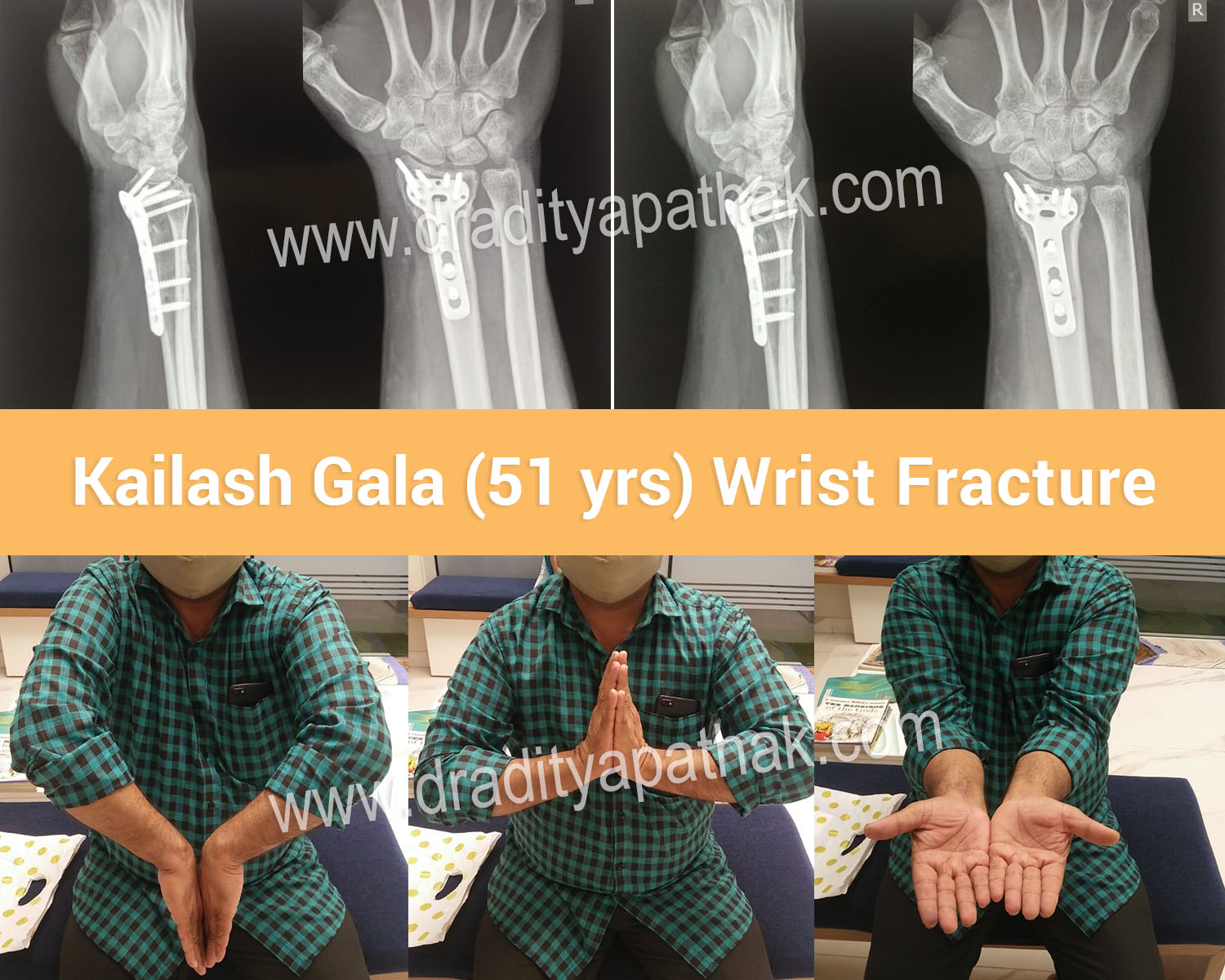 pelvic xray of 96 yr old female patient